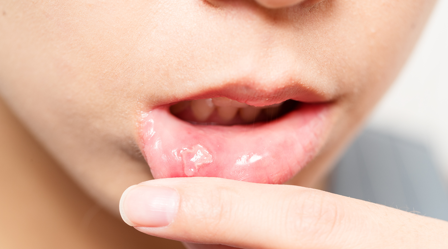 Mouth Ulcers